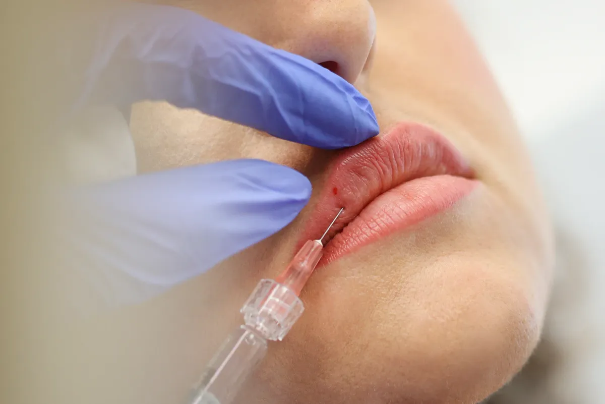 Hurting After Lip Fillers? We Have Answers for Relief