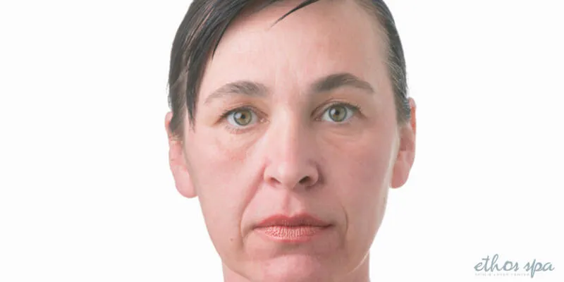 What To Do If You Get Botox Droopy Eyes