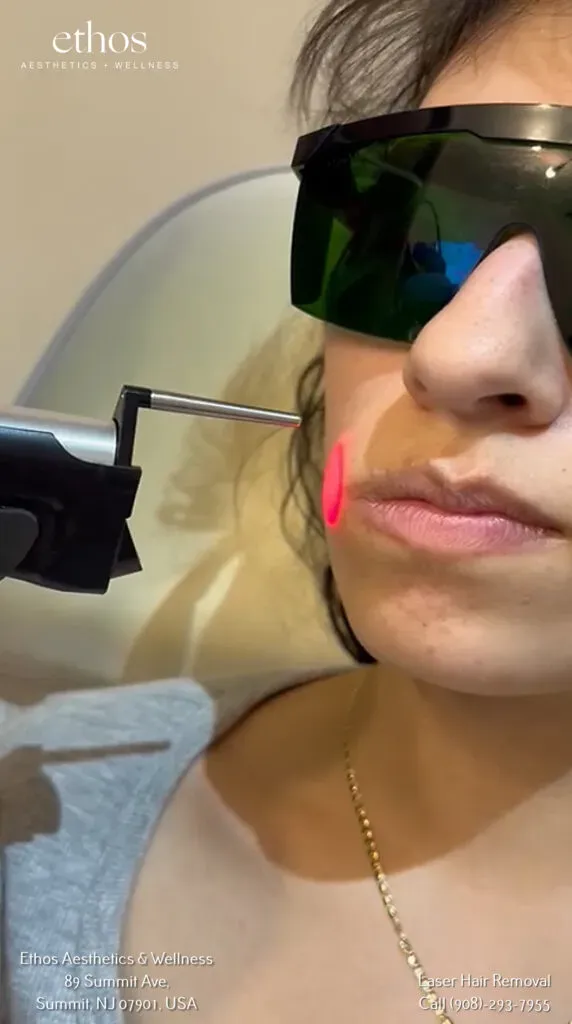 laser hair removal treatment