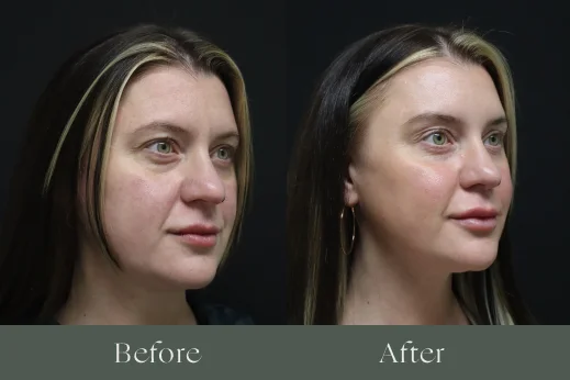 Dermal filler before and after results 1