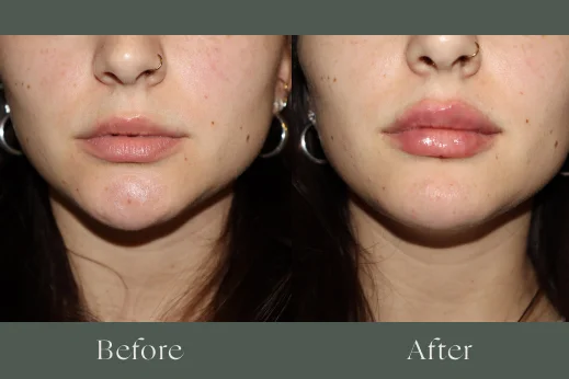 Dermal filler before and after results 11