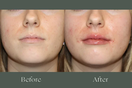 Dermal filler before and after results 12