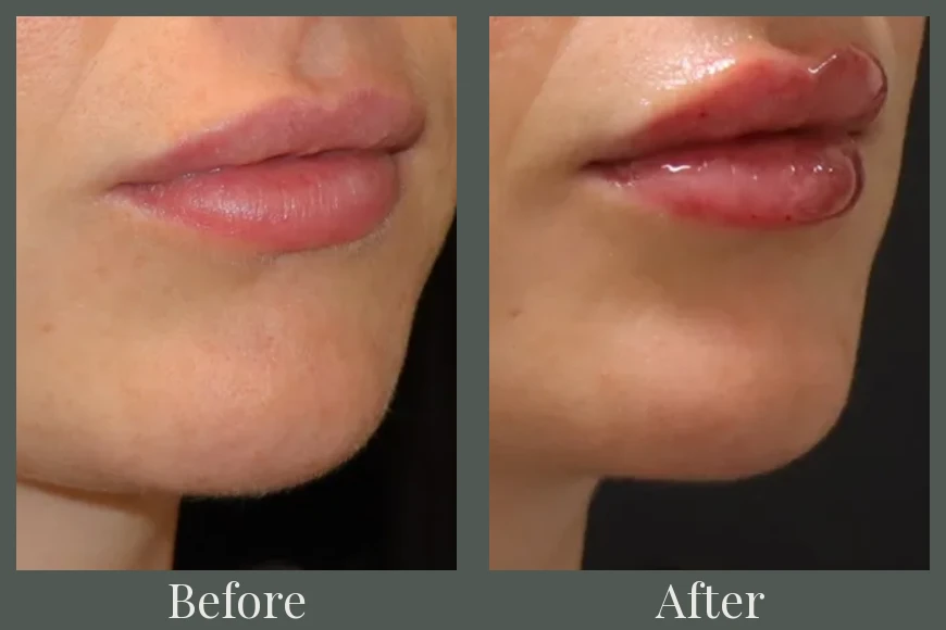 Filler before and after 18