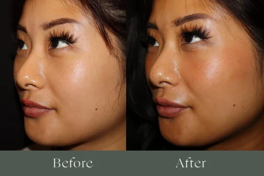 Dermal filler before and after results 3