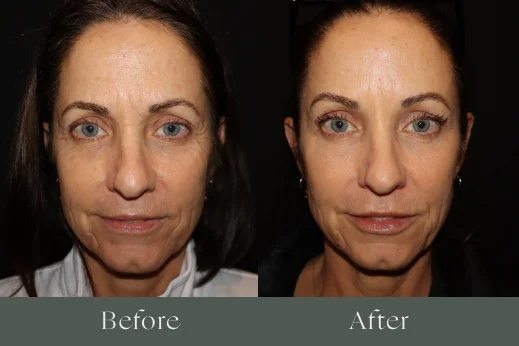 Dermal filler before and after results 5