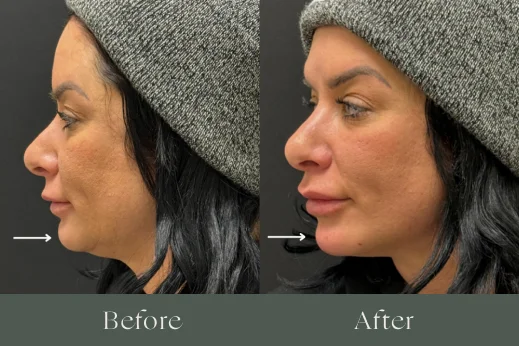 Dermal filler before and after results 6