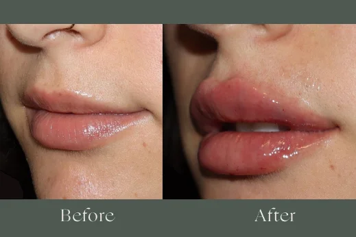 Dermal filler before and after results 9