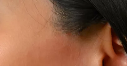 After - Laser hair removal before and after 1