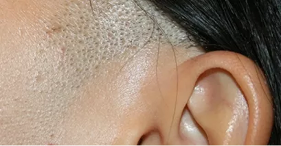 Before - Laser hair removal before and after 1