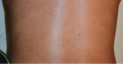 After - Laser hair removal before and after 2