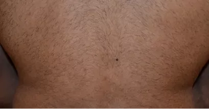 Before - Laser hair removal before and after 2