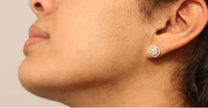 After - Laser hair removal before and after 3