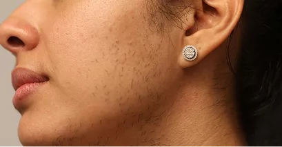 Before - Laser hair removal before and after 3