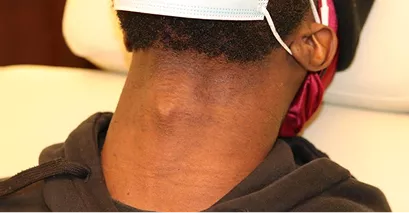 After - Laser hair removal before and after 4