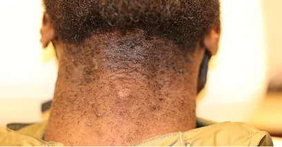 Before - Laser hair removal before and after 4