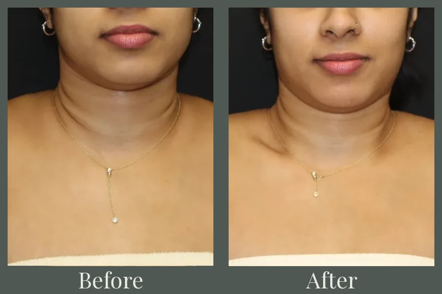 Botox before and after results 18