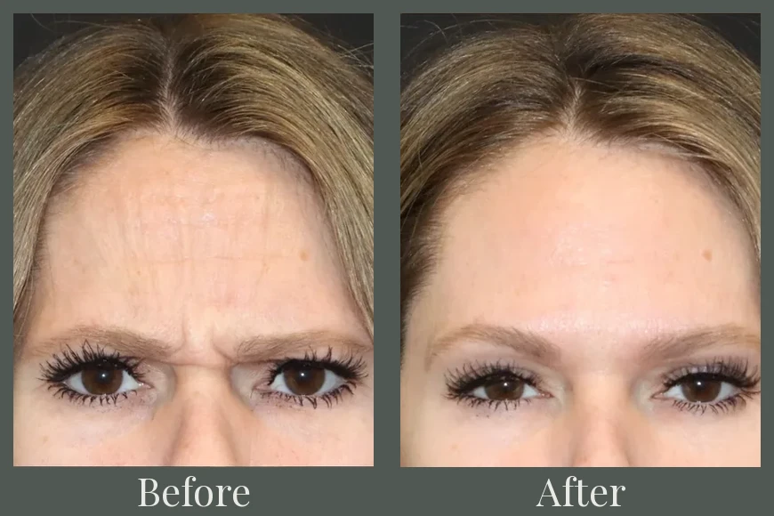 Botox before and after results 15