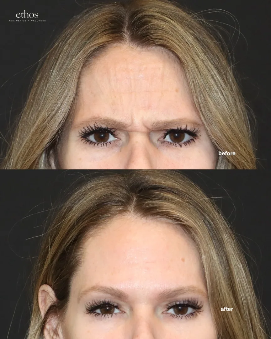 Botox before and after results 15