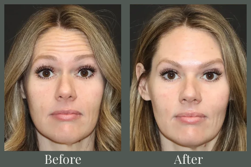 Botox before and after results 16
