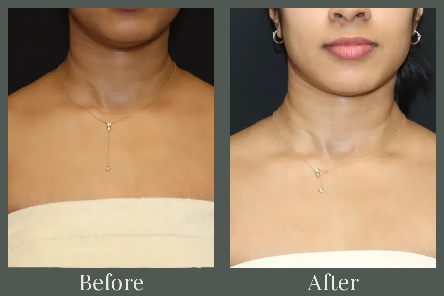 Botox before and after results 17