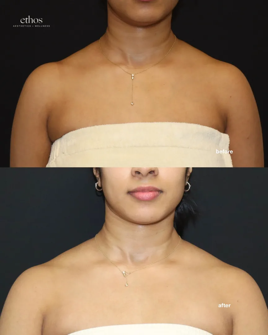 Botox before and after results 17