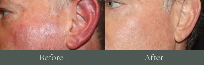 Derma V laser before and after