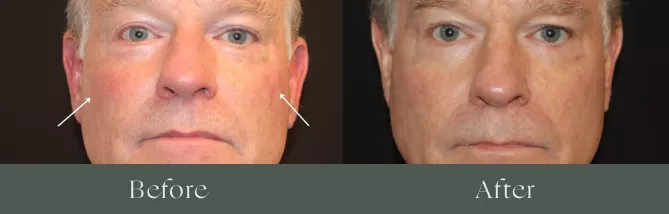 Derma V laser before and after