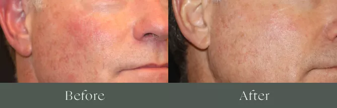 Derma V laser before and after