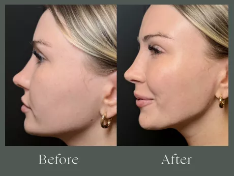 Jawline filler before and after results 23