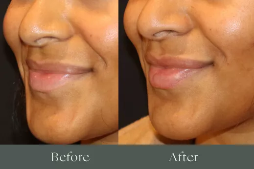 Lip filler before and after results 18