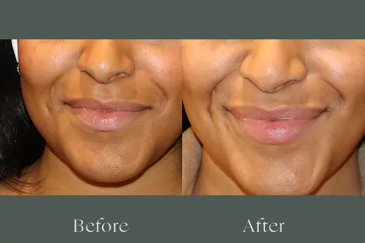 Lip filler before and after results 19