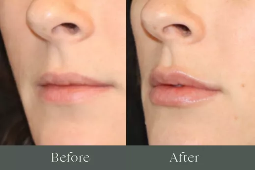 Lip filler before and after results 21
