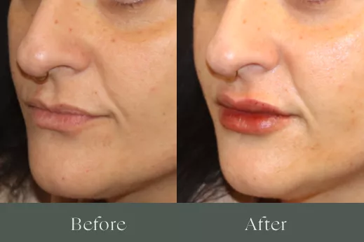 Lip filler before and after results 22