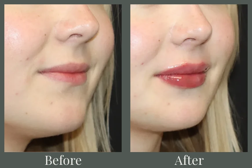 Lip filler before and after results 24