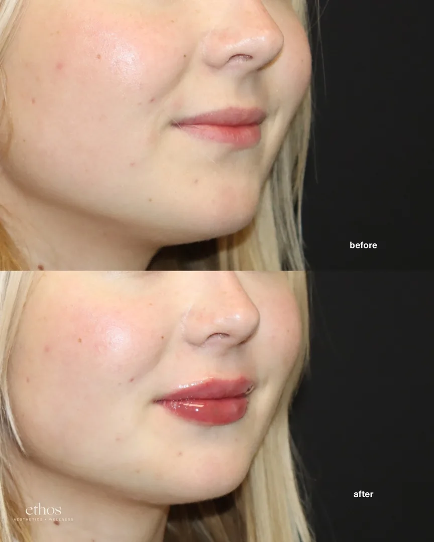 Lip filler before and after