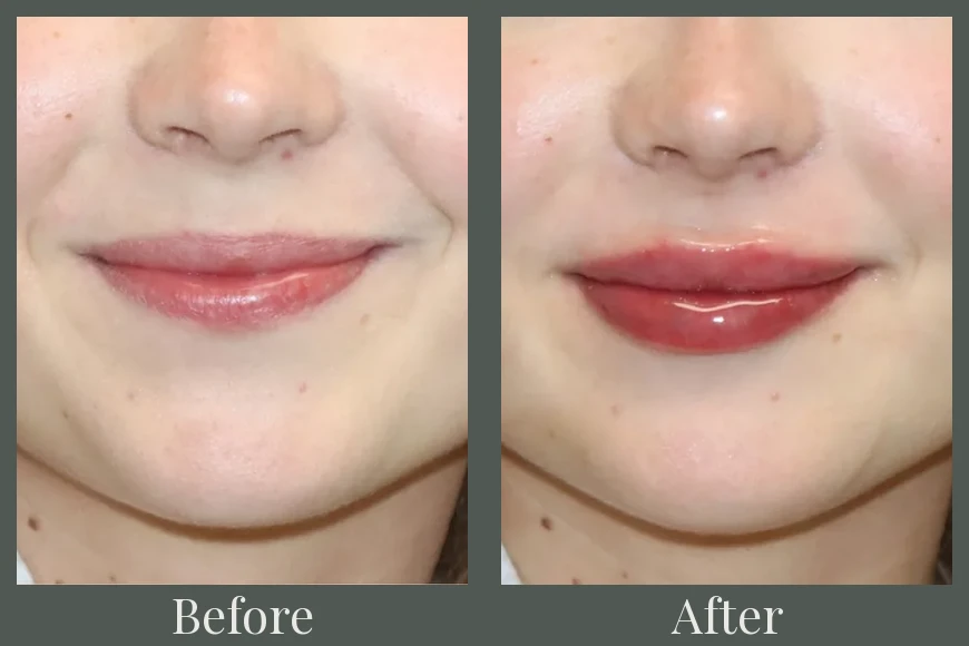 Lip filler before and after results 25