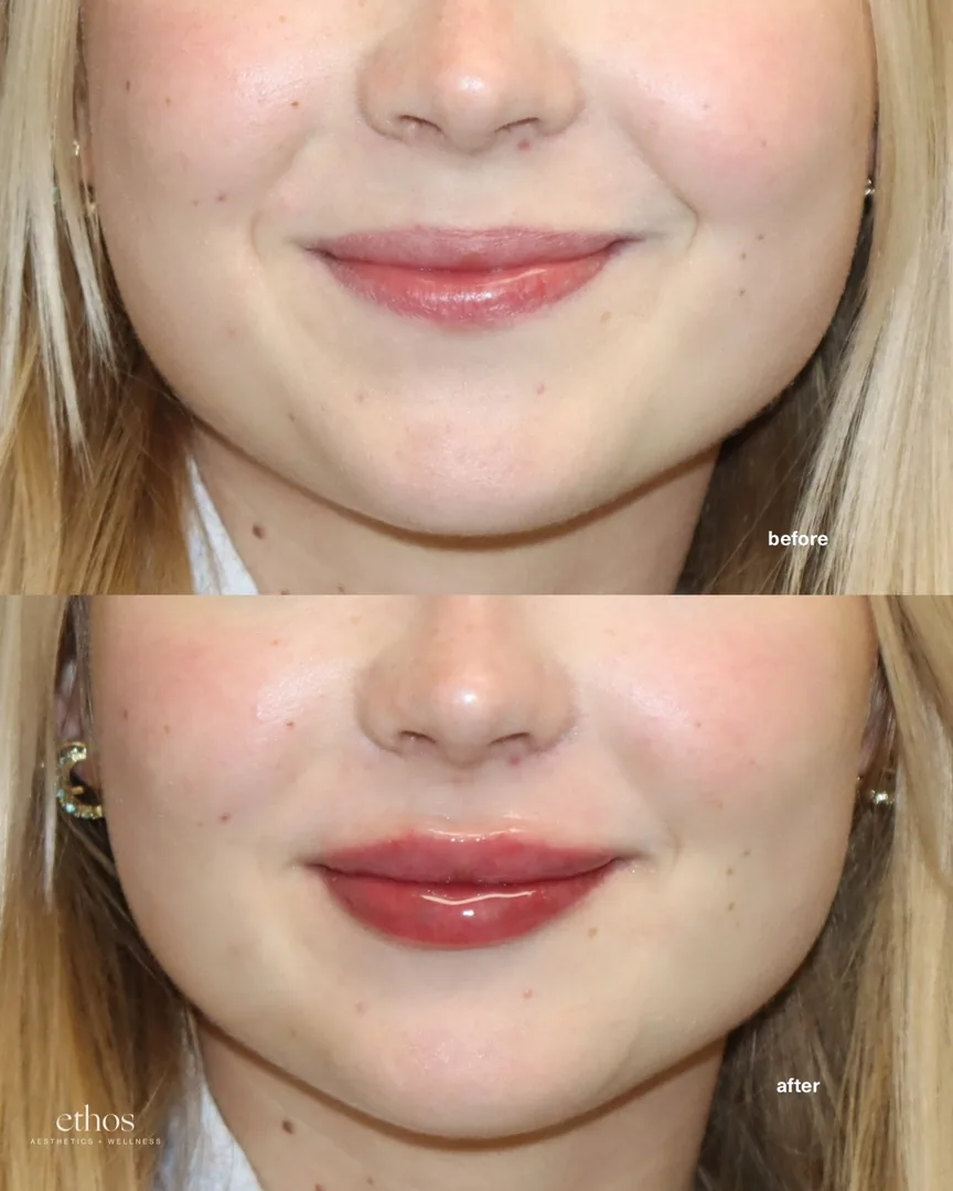 Lip filler before and after