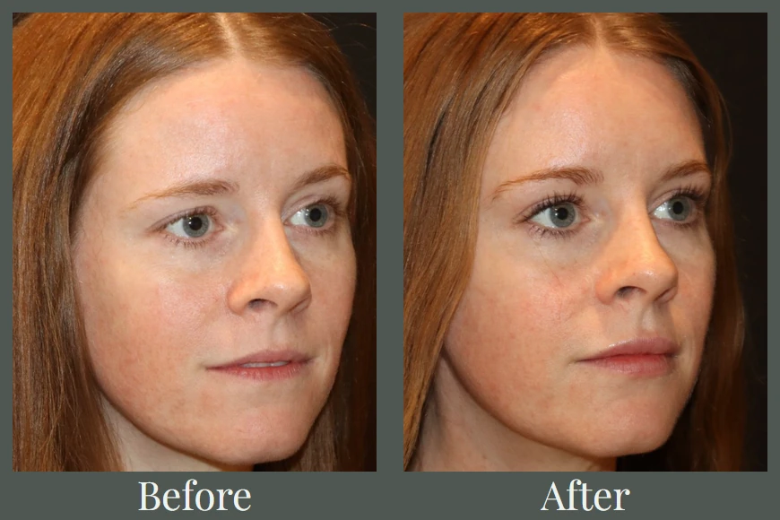 Lip filler and Botox before and after — three-quarter view
