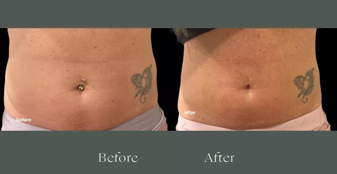 Emsculpt before and after results 1