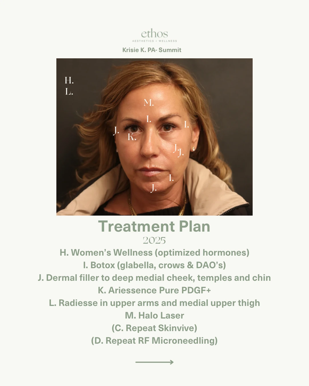 Case study treatment plan 2025 — wellness, Botox, dermal filler, Radiesse, Halo laser