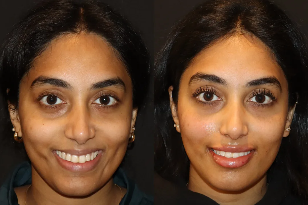 Facial balancing before and after