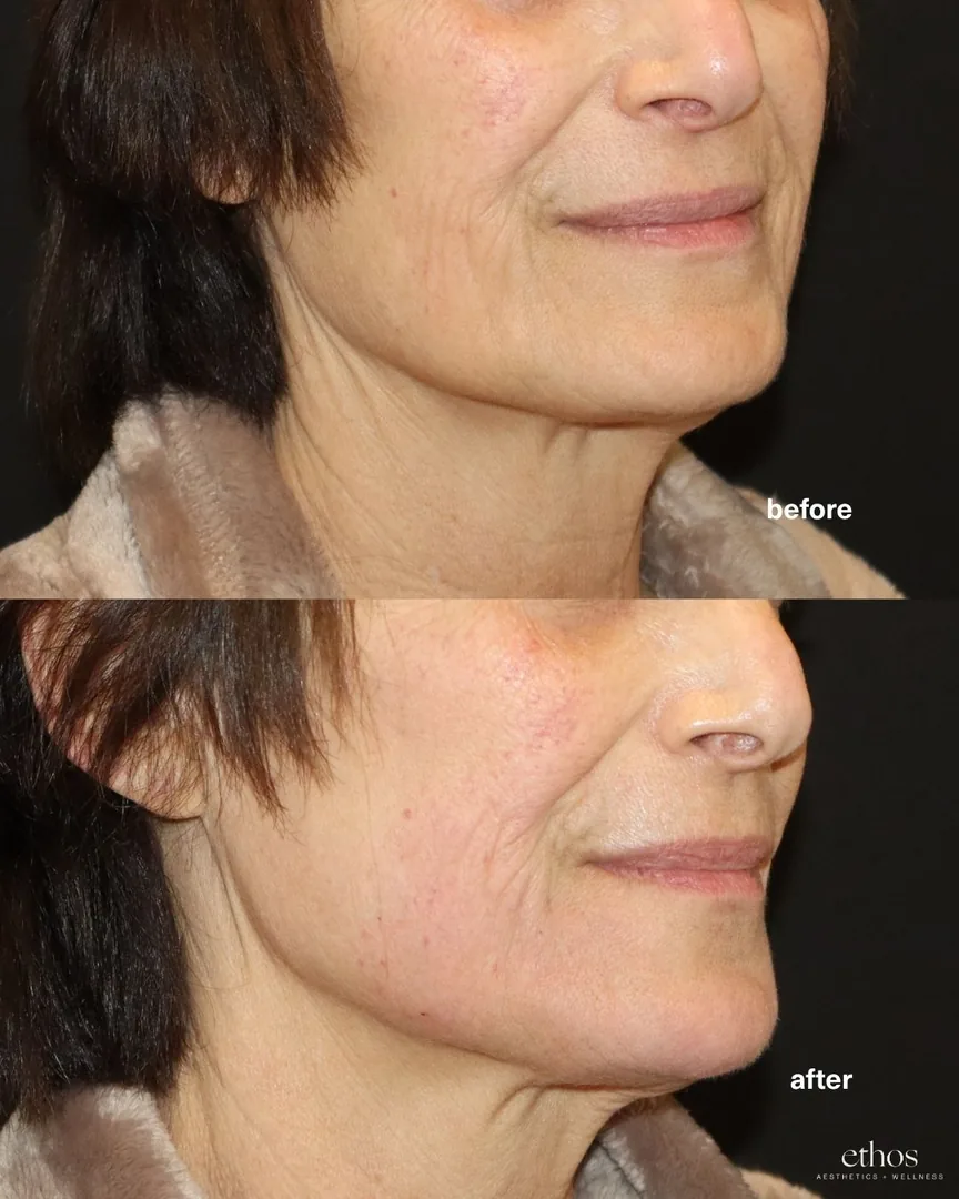 Facial balancing before and after