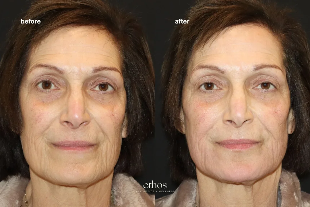 Facial balancing before and after