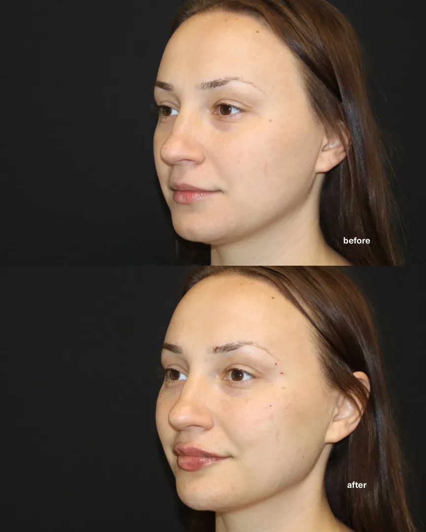 Facial balancing before and after