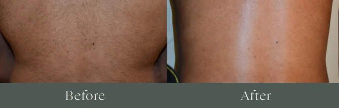 Laser hair removal before and after results 2