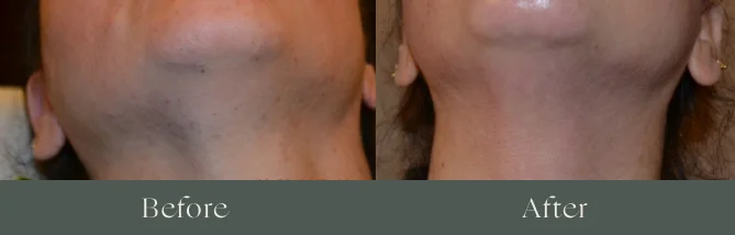 Laser hair removal before and after results 5