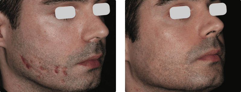 M22 laser treatment before and after results 1