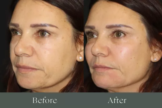 Radiesse before and after results 1