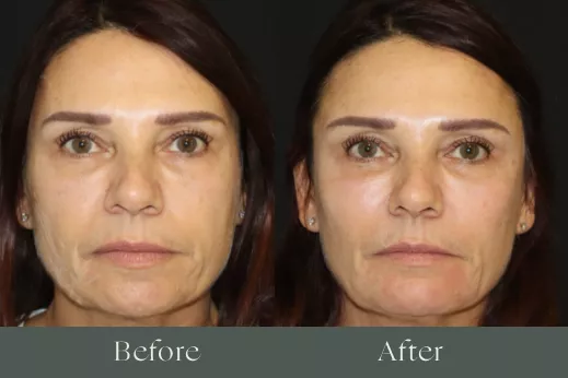 Radiesse before and after results 2