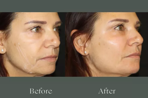 Radiesse before and after results 3